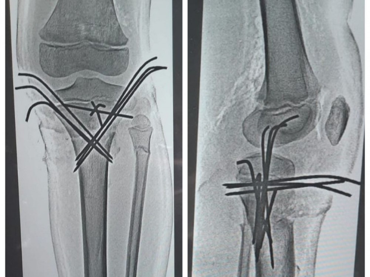 Волгоградские медики ставят на ноги подростка с 23 переломами